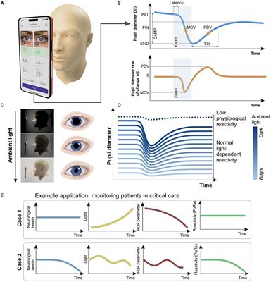 Machine learning approach for ambient-light-corrected parameters and the Pupil Reactivity score in smartphone-based pupillometry